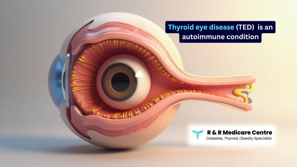 What Is Thyroid Eye Disease - best thyroid doctor in Jabalpur